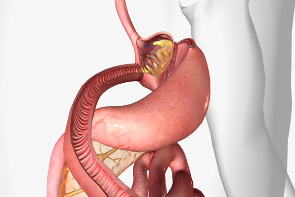 Gastrik Bypass